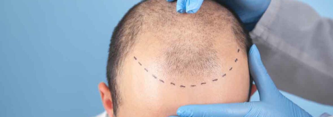 Hair Transplant