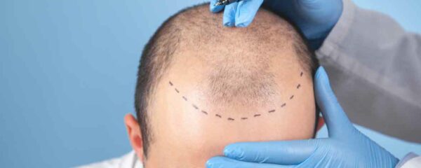 Hair Transplant