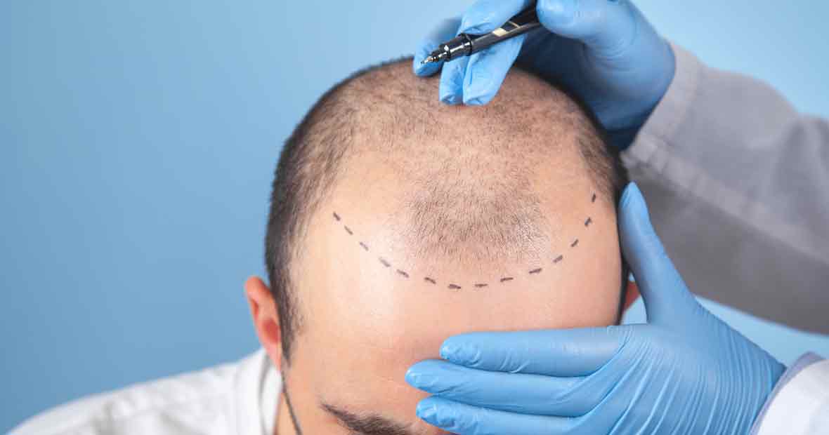 Hair Transplant